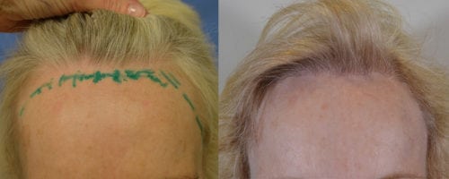 59 year old female with high hairline. Single session 1500 1-4 hair follicular units grafts
