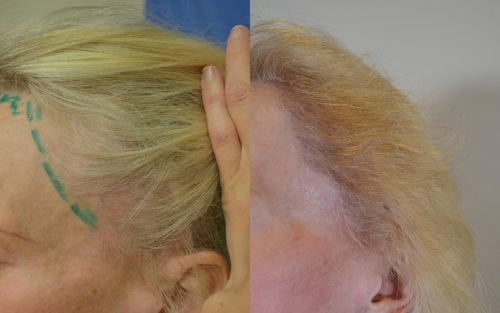59 year old female with high hairline and facelift scar. Single session 1500 1-4 hair follicular units grafts
