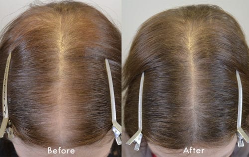 finasteride results Archives - Hair Restoration of the South finasteride results Archives - Hair Restoration of the South