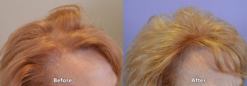 This 77 y/o female - 1408 grafts to help fortify her frontal hairline, temporal recessions, and overall volume and fullness. 