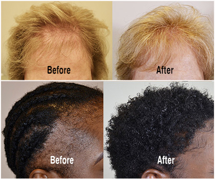 New Orleans Hair Transplant Surgeon, Dr. Nicole Rogers | FUE & FUT Hair  Restoration