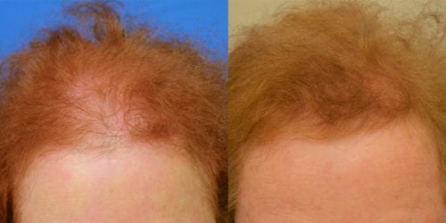 Female - Before & After Hair Transplant