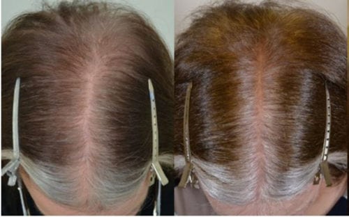 62 year old female patient started with minoxidil and finasteride but didn't tolerate minoxidil. After (R) 6 months after starting treatment.