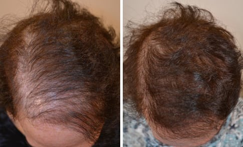 62 year old female with female diffuse alopecia before and 1 year post-op