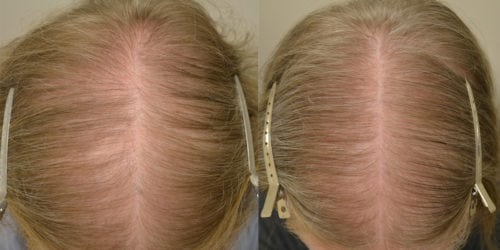 Before and 30 months after initiating finasteride  and topical minoxidil treatment