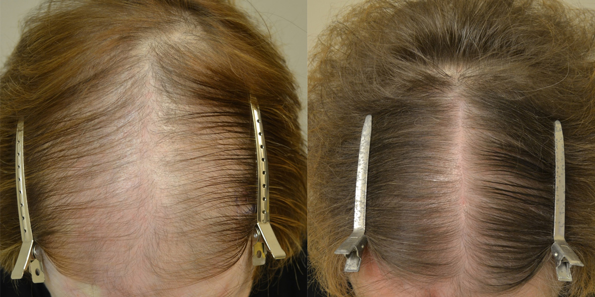 Minoxidil Before After Female