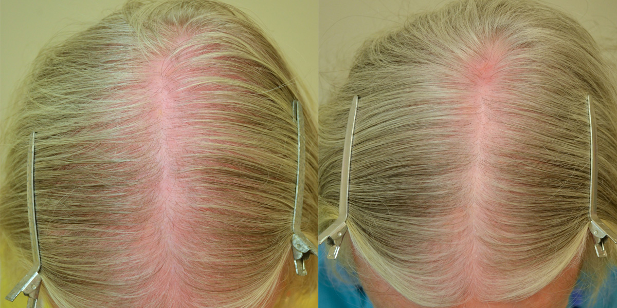Finasteride (Females) Before & After Photos Hair Restoration of the