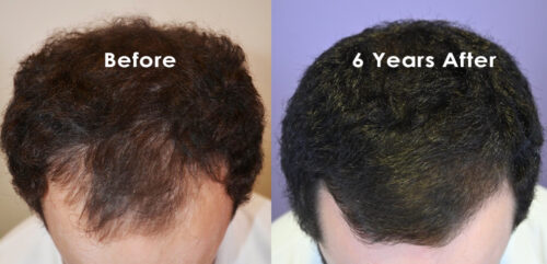  Before and after 6 years of finasteride 1mg / day + 1 year of oral minoxidil 2.5mg/day