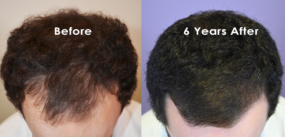 Propecia before and after photos - Dr Rogers - New Orleans