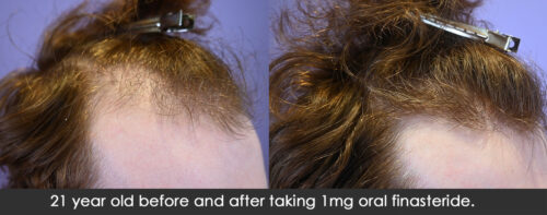 21 year old before and after taking 1mg oral finasteride. 