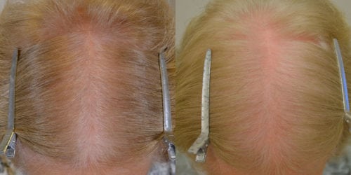 75 year old female on finasteride 5mg daily and using topical minoxidil 5% twice weekly for 7 months . 