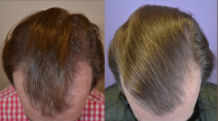 Oral Finasteride Follow Up After  Years - Hair Restoration of the South
