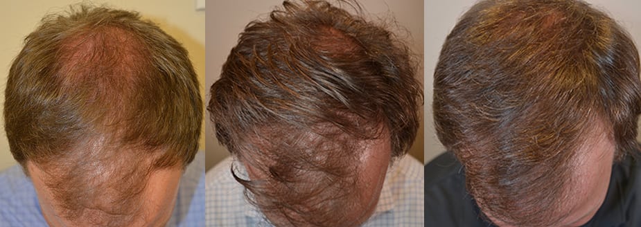Four Year Finasteride Hair Thickening Result - Hair Restoration of the South