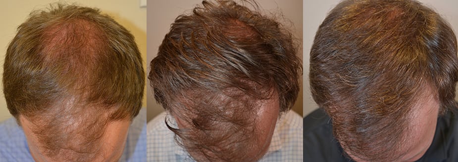 Four Year Finasteride Hair Thickening Result - Hair Restoration of the South Four Year Finasteride Hair Thickening Result - Hair Restoration of the South