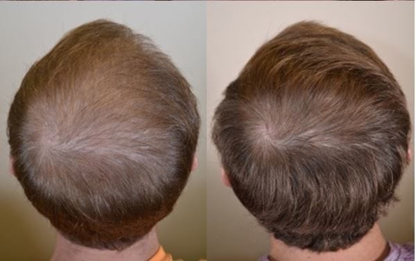 does hims work for hair loss