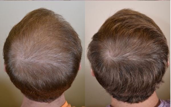 Propecia before and after photos - Dr Rogers - New Orleans Propecia before and after photos - Dr Rogers - New Orleans