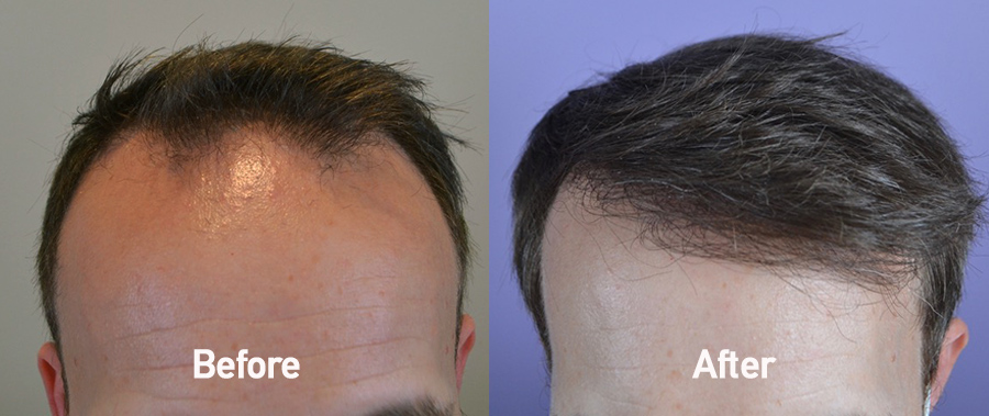 FUE Hair Transplant & Medical Therapy Case Study - Hair Restoration of the  South