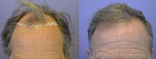 FUT Procedure - before and after 1200 grafts to recreate the frontal zone for 66 year old patient.