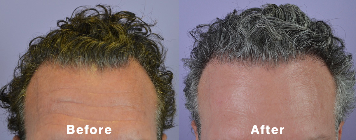 Case Study Archives - Page 2 of 10 - Hair Restoration of the South