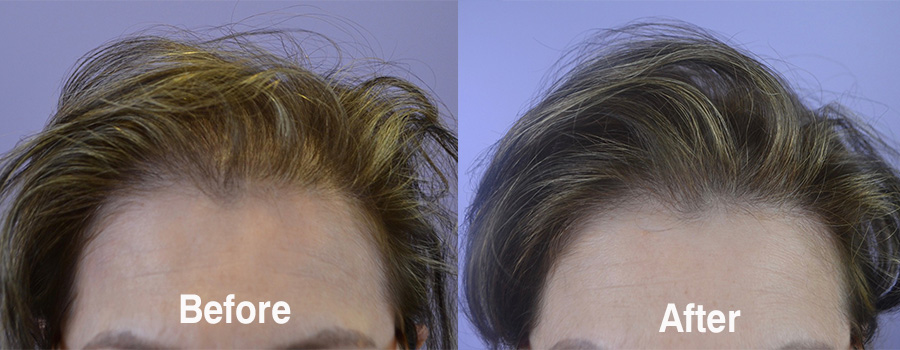 Female Hair Transplant 1,745 Grafts - Hair Restoration of the South