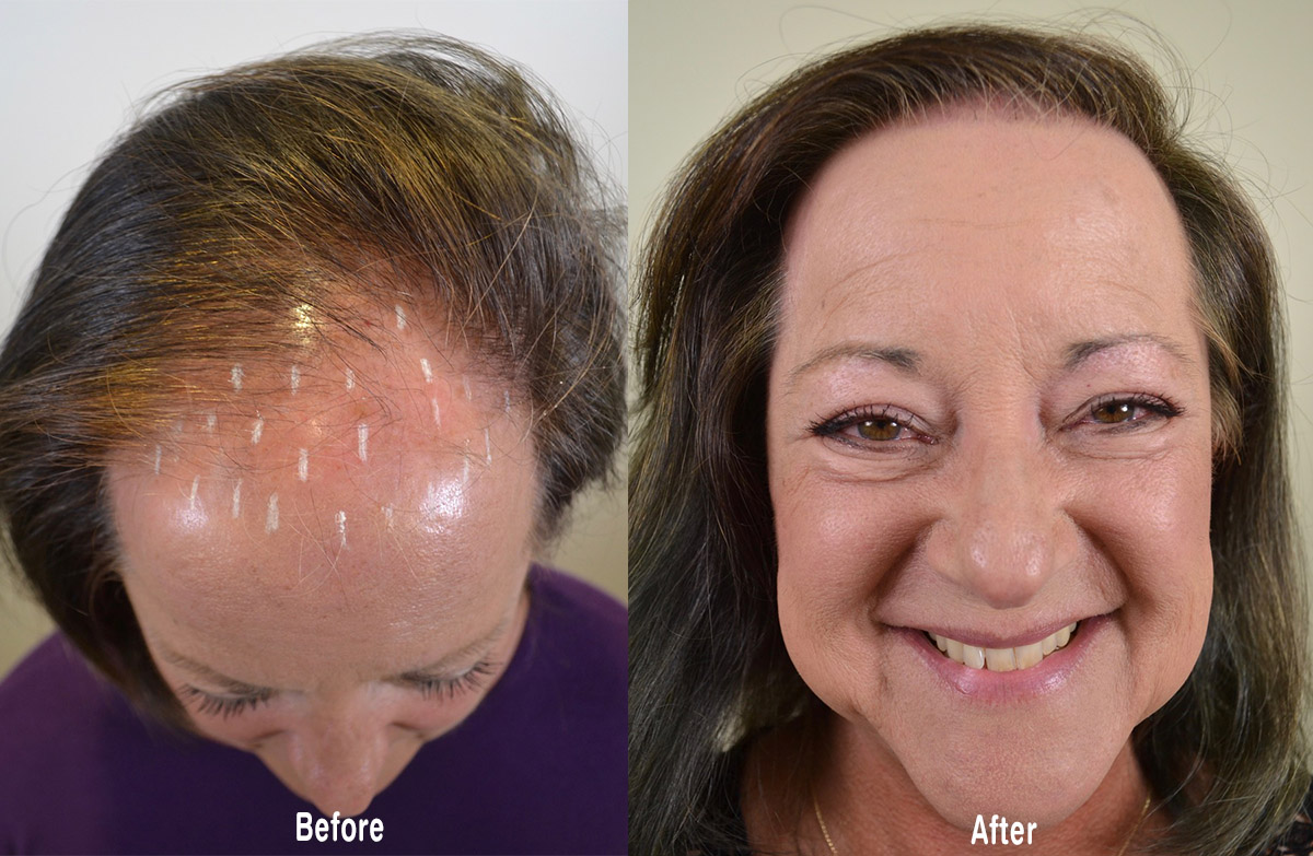 topical minoxidil Archives Hair Restoration of the South
