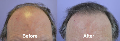 Before and after 2082 hair grafts.