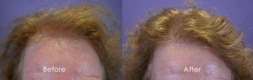 Front-Female Hairline-Restoration