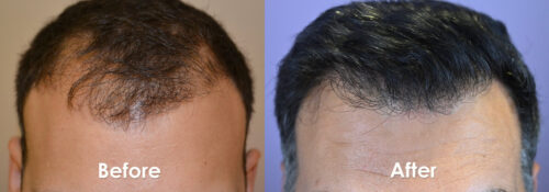 Hair-Transplant-Front