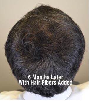 can you take finasteride before hair transplant