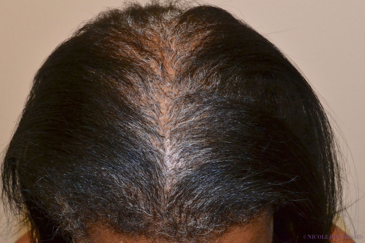African American Hair Transplant New Orleans Louisiana