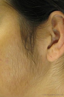 Minoxidil (Rogaine) for men and woman experiencing hair loss - Hair Restoration Louisianna Minoxidil (Rogaine) for men and woman experiencing hair loss - Hair Restoration Louisianna
