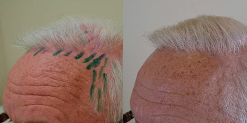 Patient is 71 year old male with previous hair transplantation over 20 years ago. He wanted more density and to lower left frontal hairline. FUE and Strip harvest methods both used.