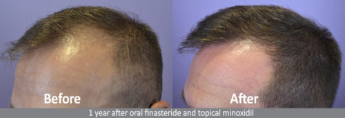 1 year after oral finasteride and topical minoxidil