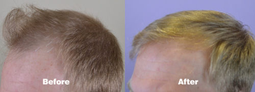 Left-Hairline1760Grafts