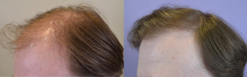 31 year old male, Norwood hair loss class 5 - 1682 grafts via FUT - post op photos at 1 year. Taking finasteride 1mg daily. 