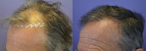 FUT Procedure - before and after 1200 grafts to recreate the frontal zone for 66 year old patient.