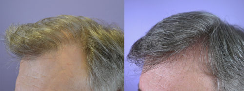 Same patient - left part view.