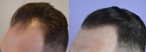 hairline hair transplant