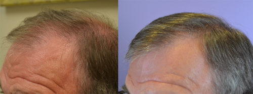 70 year old male - Norwood Hair Loss Classification 5/6 - 2 Sessions - Total of 2,943 total grafts harvested via FUT.