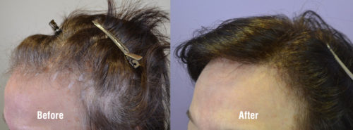66 year old female with high receded hairline before and 1 year after FUT hair transplantation.