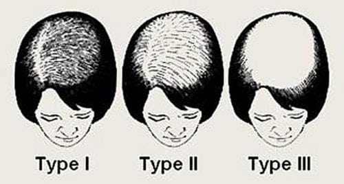 Ludwig Female Hair Loss Chart