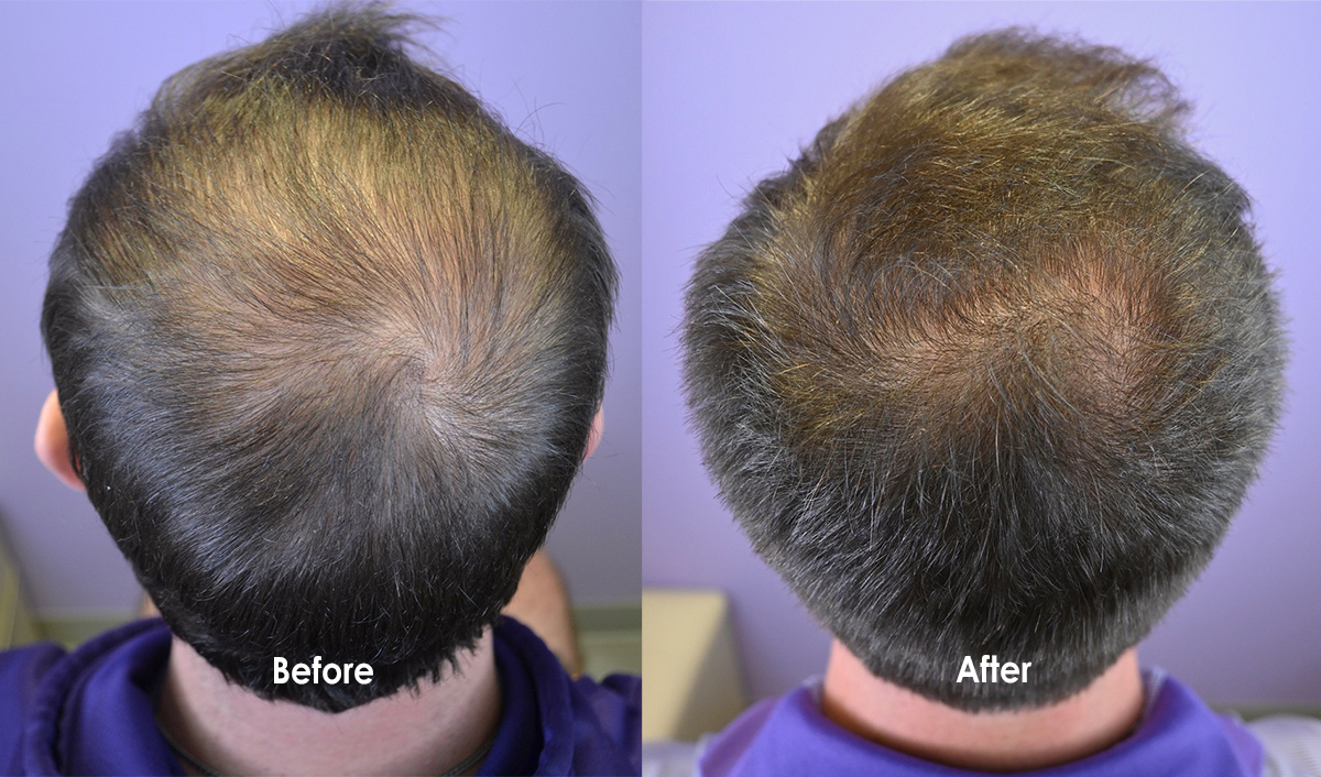 Low Dose Minoxidil Pill Prescribed For Early Hair Loss - Hair Restoration  of the South