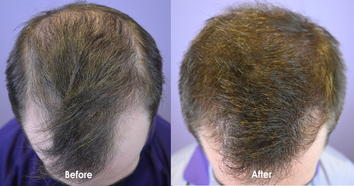 Low Dose Minoxidil For Early Hair Loss - Hair Restoration South