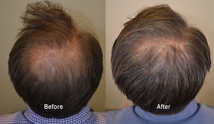 Topical Minoxidil Hair Growth Results Minoxidil Results After 6 Months - Hair Restoration of the South