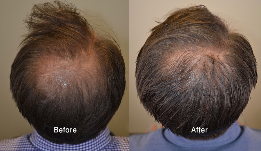 Topical Minoxidil Hair Growth Results Impressive Minoxidil Results Topical Minoxidil Hair Growth Results Impressive Minoxidil Results