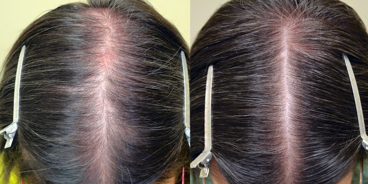 Topical Minoxidil (Females) Before & Photos - Hair Restoration the South - New Orleans, LA