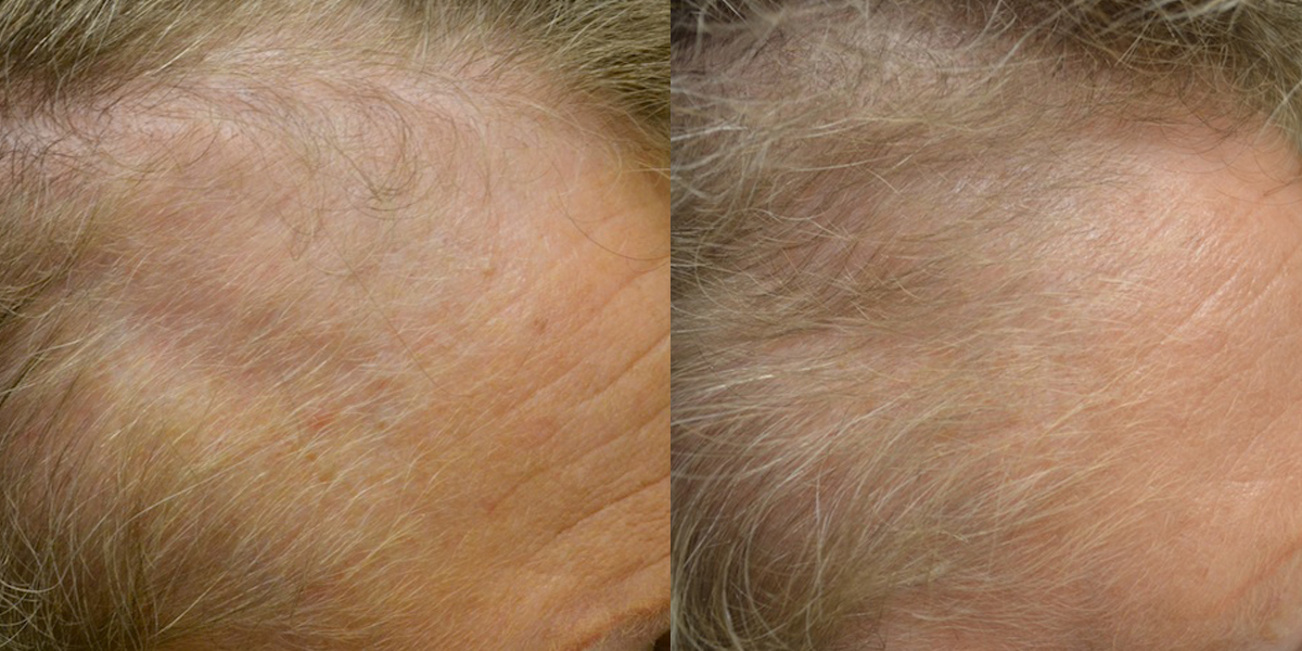 Topical Minoxidil (Females) Before & After Photos Hair Restoration of the South New Orleans, LA
