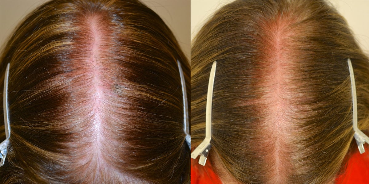 Topical Minoxidil (Females) Before & After Photos Hair Restoration of