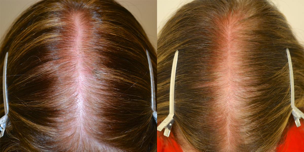 slsi.lk - how long for sulfatrim to work | Accept. rogaine 5 minoxidil