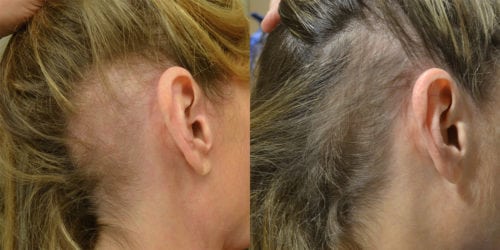 Before and after PRP Hair Loss Injection Therapy. Back of Neck